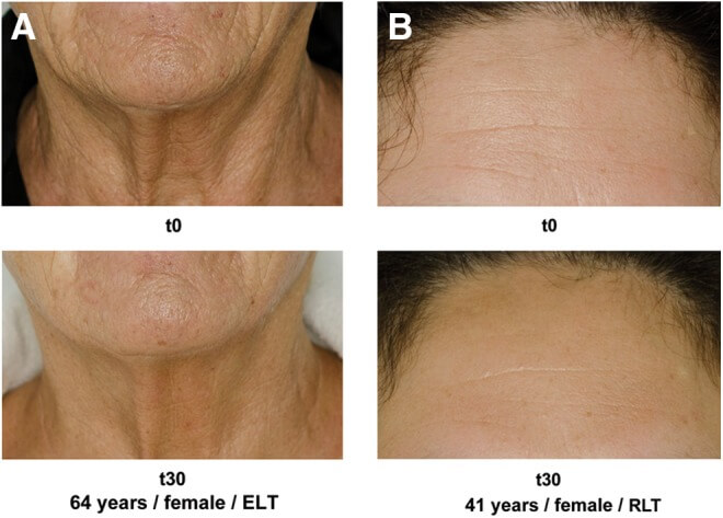 Rotlicht Photobiomodulation Haut Falten Effekt Anti Aging Therapie Rotlicht Photobiomodulation Haut Falten Effekt Anti Aging Therapie